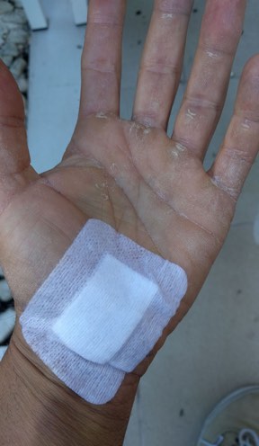 Juan's bandaged hand post surgery
